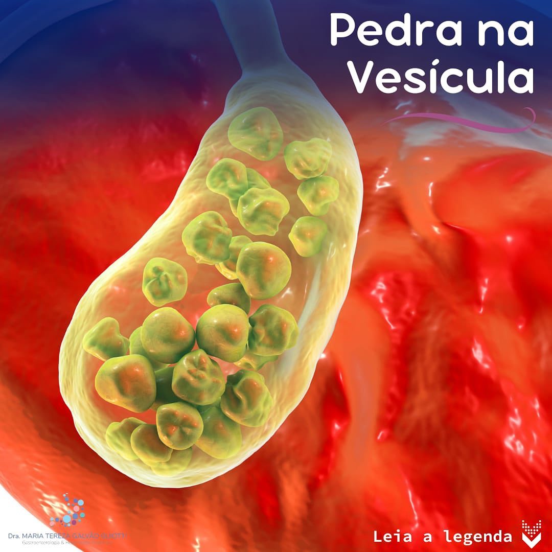 Pedra na vesícula, pop pediatria, dra maria tereza, gastropediatria, gastro, hepato, pediatria, pinheiros, são paulo, pedra, mecanismos, hipóteses, mecânico, dieta, cirurgia