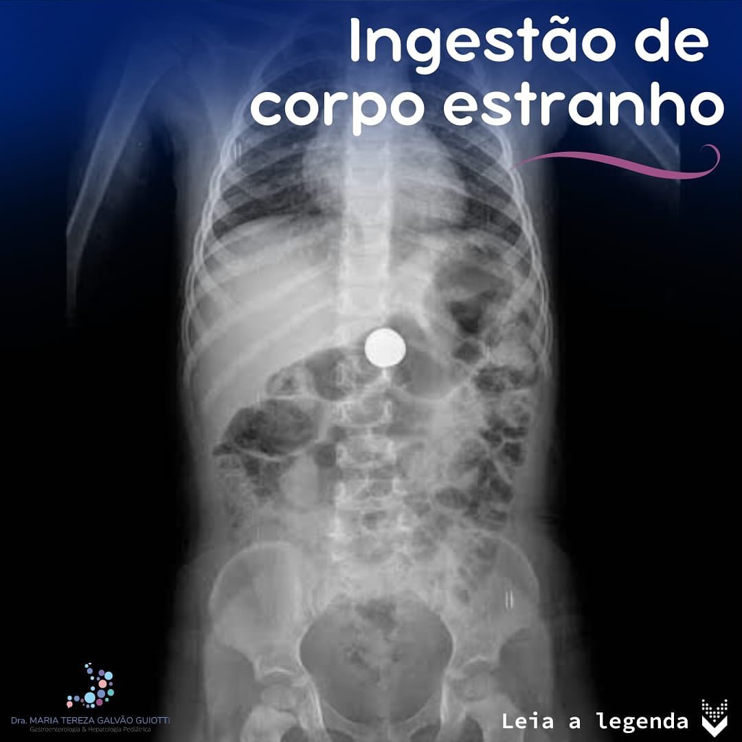 Ingestão de corpo estranho, pop pediatria, dra maria tereza, gastropediatria, gastro, hepato, pediatria, pinheiros, são paulo, ingestão, estranhos, pontiagudos, ímãs, orofaringe, sintomas